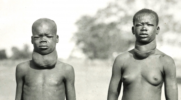  Wole (przerost tarczycy).  