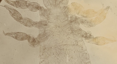  Zdjęcie mikroskopowe żeńskiego osobnika wszy głowowej.  